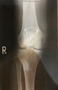 knee-fracture-surgery-1