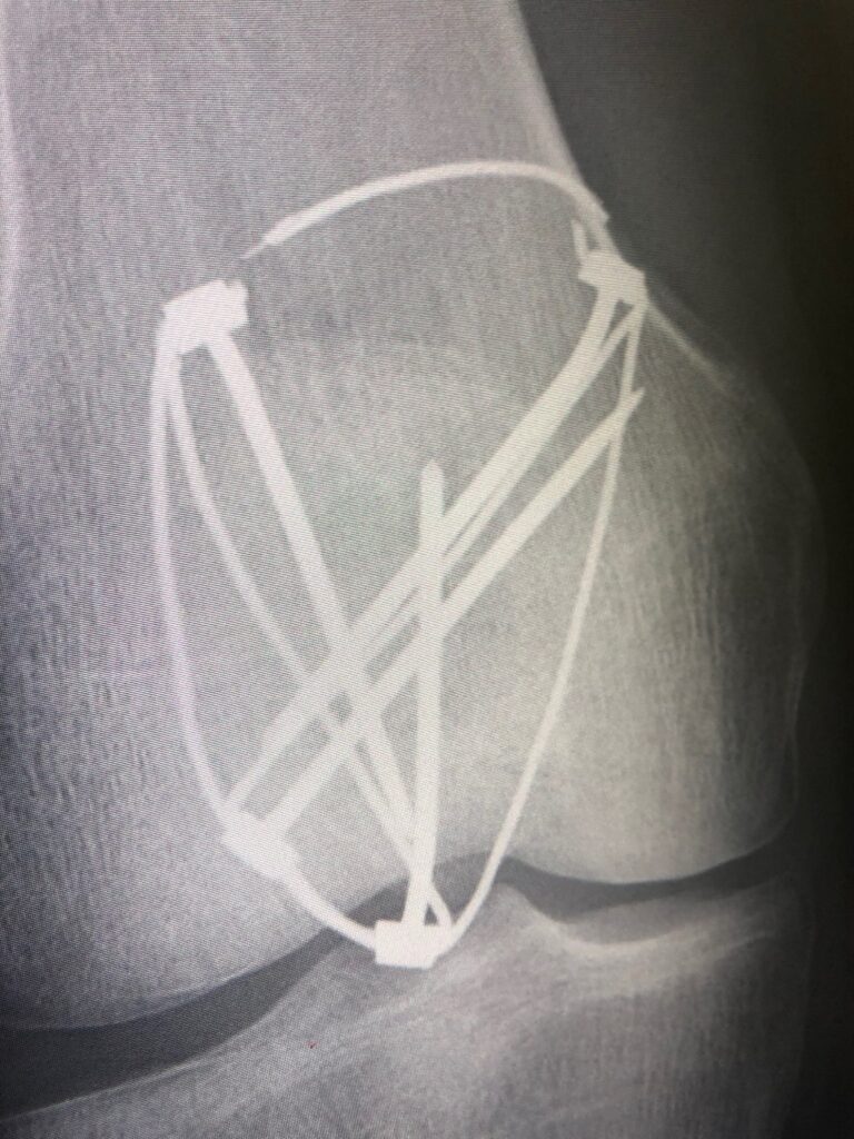 knee-fracture-surgery-2