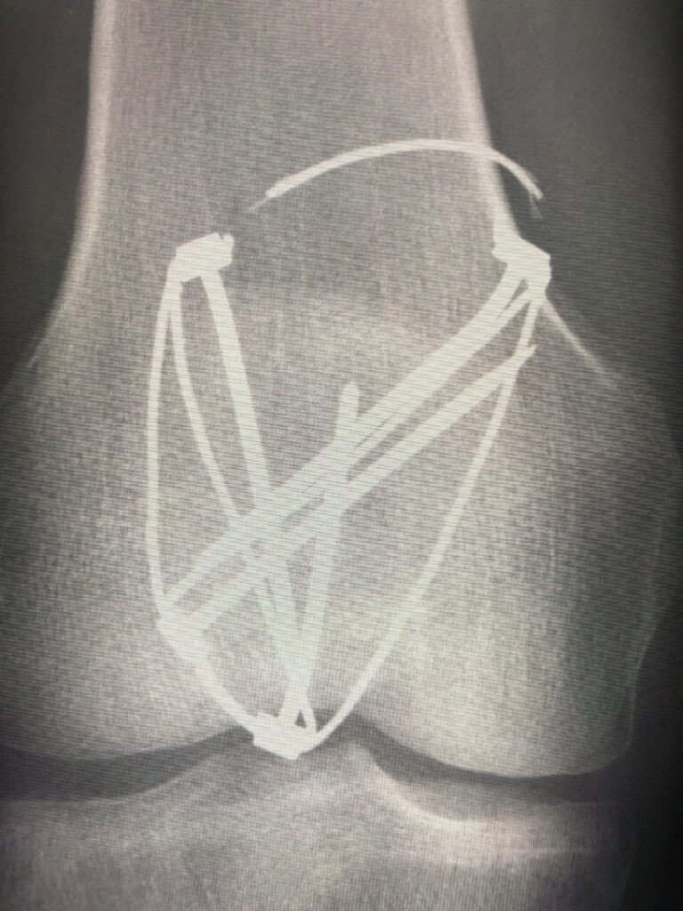 knee-fracture-surgery-3